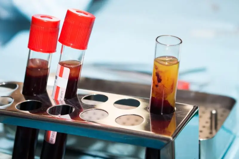 i-PRF в стоматологии