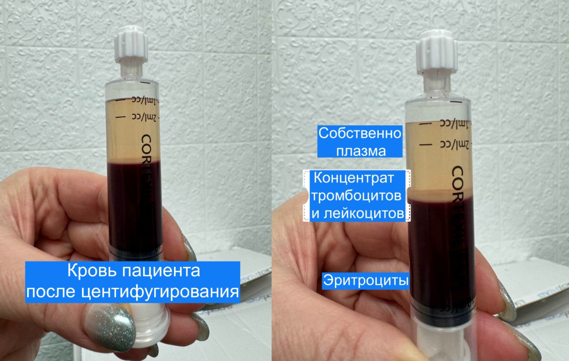 PRP в стоматологии