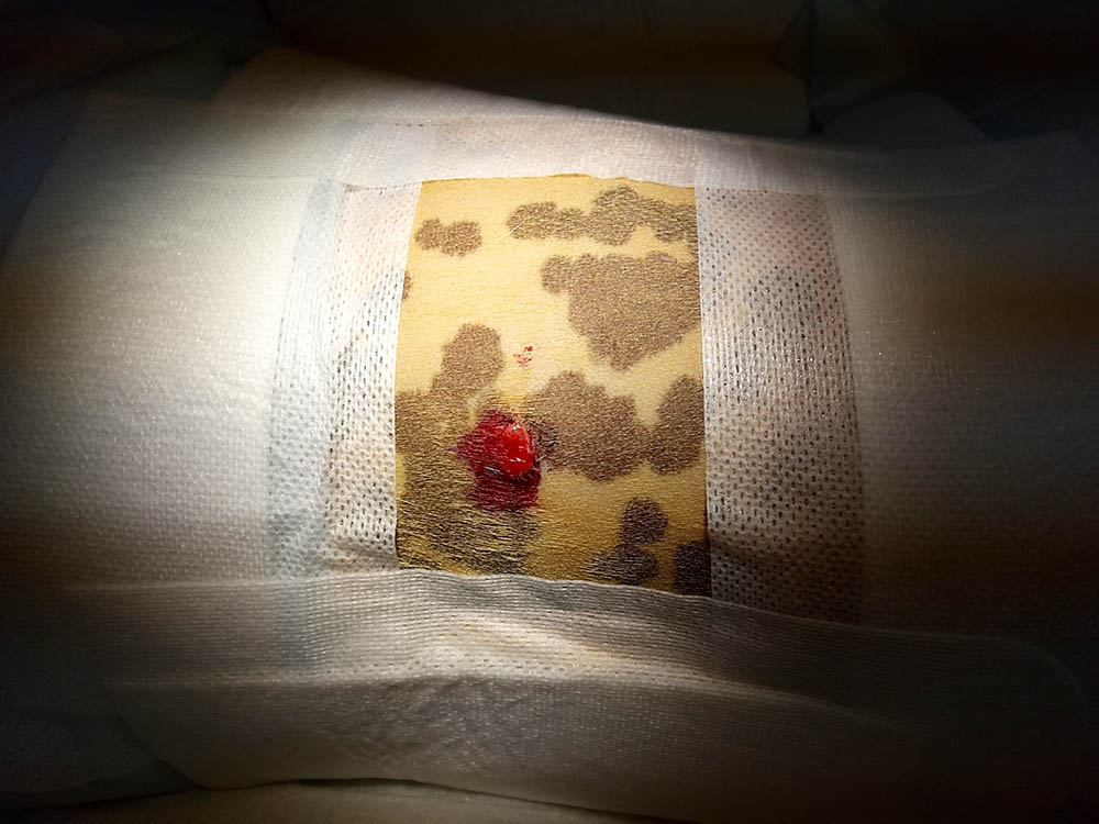mastocytoma-1.jpg